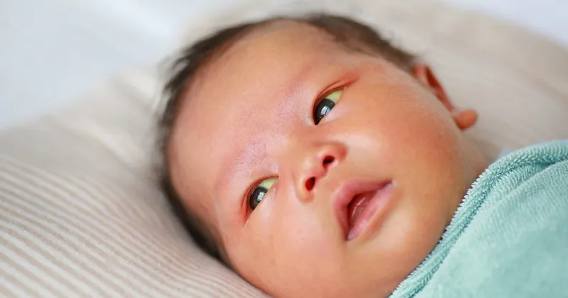 Trẻ sơ sinh bị vàng da: Dấu hiệu và triệu chứng là gì?