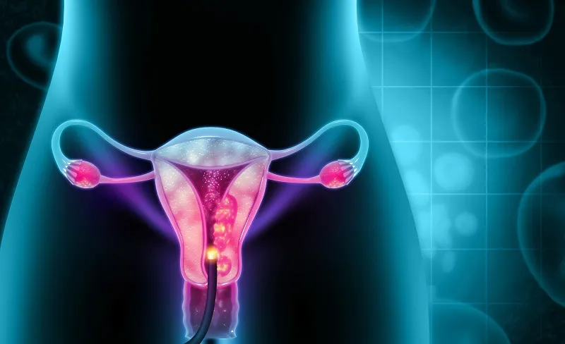 Ung thư nội mạc tử cung là gì? Nguyên nhân, dấu hiệu, cách điều trị