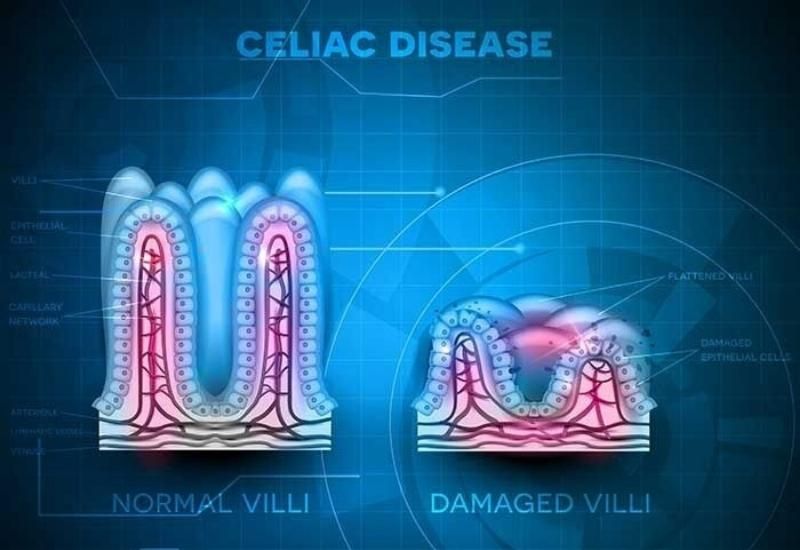 Celiac là bệnh gì? Dấu hiệu, triệu chứng và nguyên nhân