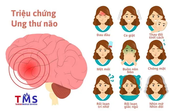 Ung Thư Não Biểu Hiện: Triệu Chứng Cần Biết Để Phát Hiện Sớm