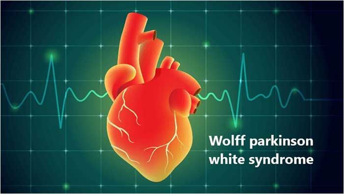 Hội chứng Wolff-Parkinson-White (WPW) là gì? Triệu chứng và nguyên nhân