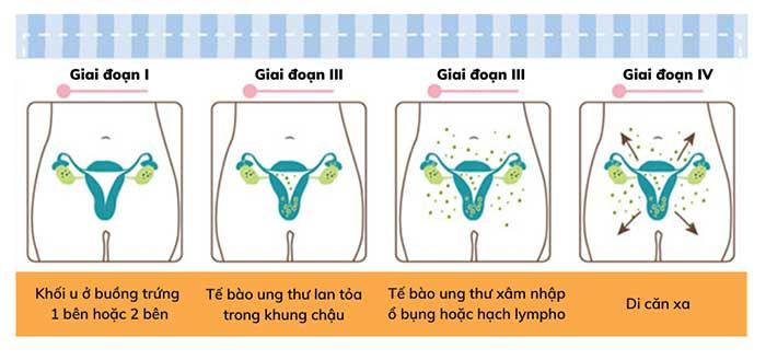 Dấu hiệu, biểu hiện và nguyên nhân gây ung thư buồng trứng