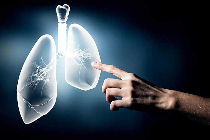 Nguyên nhân, yếu tố nguy cơ và cách phòng tránh Ung thư phổi