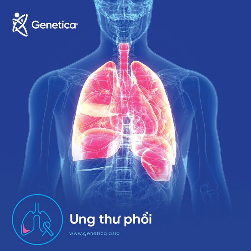 Triệu chứng và dấu hiệu nhận biết sớm của bệnh Ung thư phổi